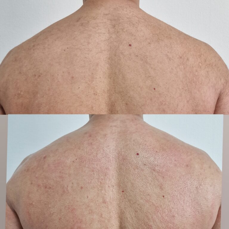 Laser ontharing resultaat